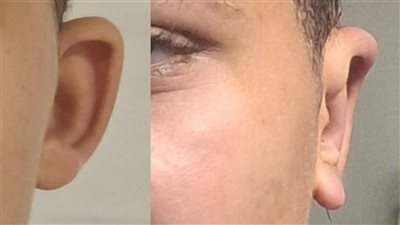 إنجاز طبي جديد بمستشفى كفر سعد المركزي في جراحات التجميل