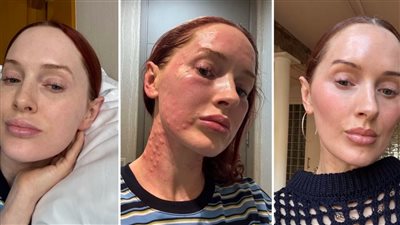 ترند التجميل بحقن الريجوران يتصدر ترند التيك توك وتحذيرات عالمية منه