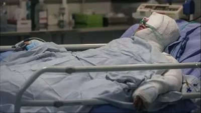 سقطت عليه مادة كاوية.. إصابة عامل بحروق من الدرجة الثالثة في عمله بشرق بورسعيد