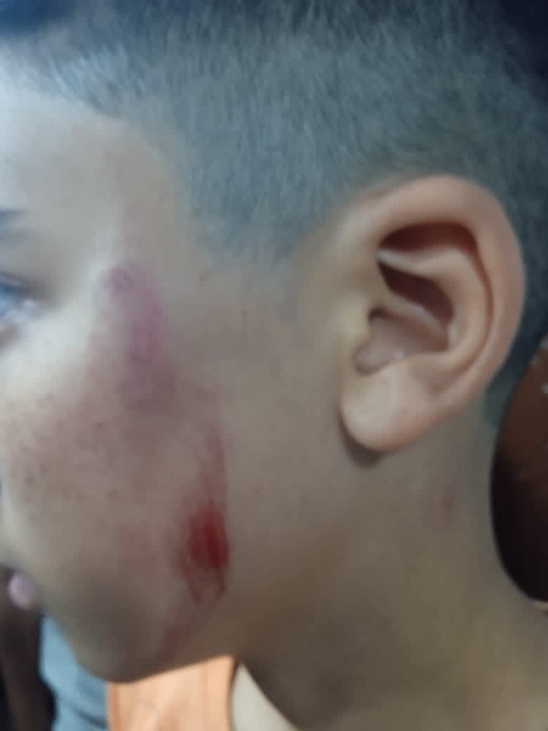 اثار الضرب بوجه الطالب&nbsp;