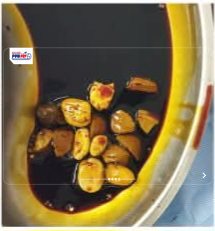 صورة من الأحجار التي ابتلعها الطفل في المنيا
