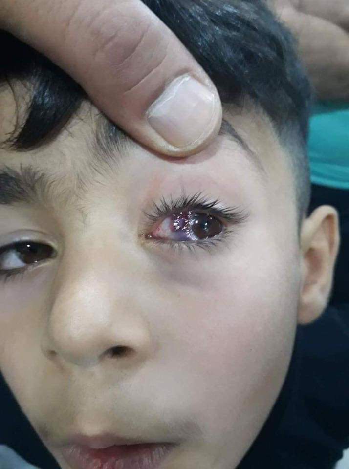أحد ضحايا الالعاب النارية