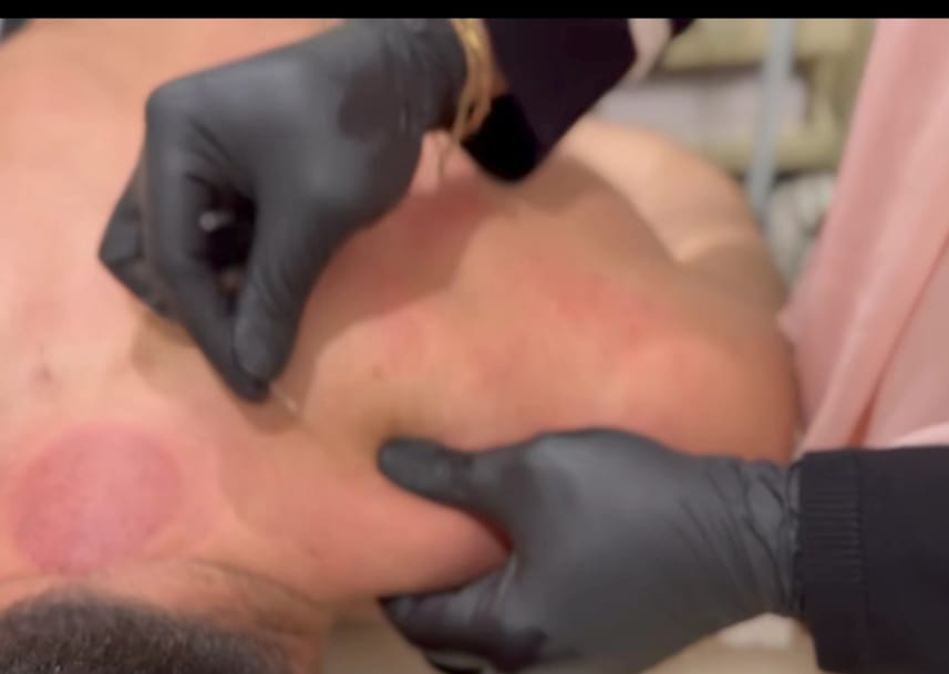 خلال العلاج بالحجامة