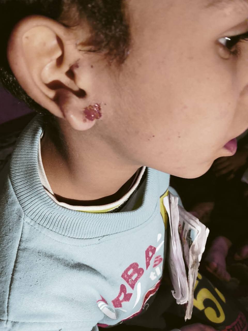 آثار الضرب على وجه الطفل