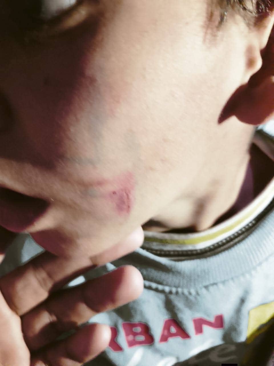 آثار الضرب على وجه الطفل