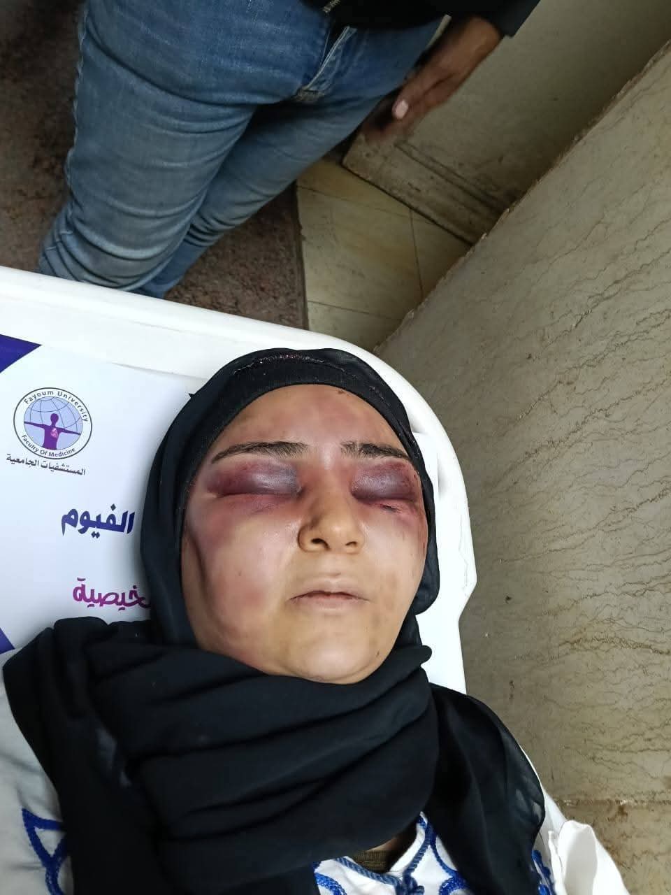 أصابات بالغة بالوجه واليدين… زوج يعتدي بالضرب علي زوجته بالفيوم
