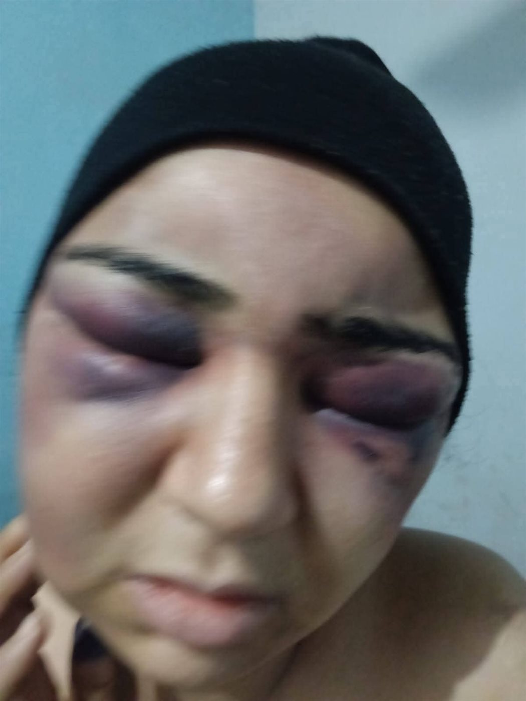أصابات بالغة بالوجه واليدين… زوج يعتدي بالضرب علي زوجته بالفيوم