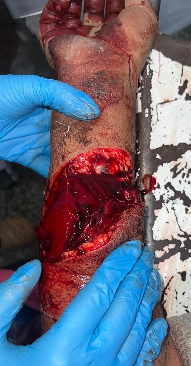 فريق جراحات التجميل بمستشفى الفيوم العام .. ينجح فى أنقاذ شاب من بتر زراعة&nbsp;