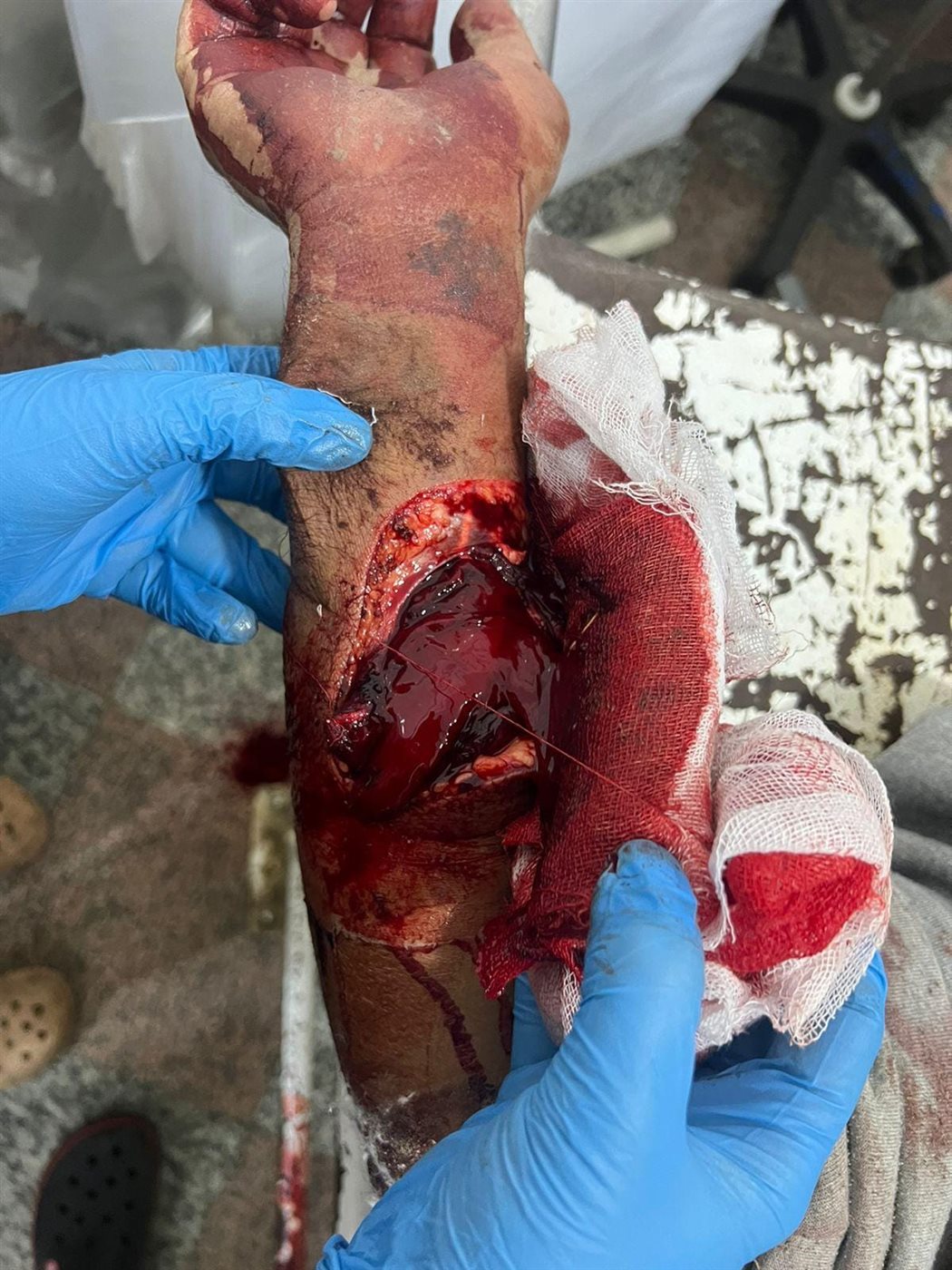 فريق جراحات التجميل بمستشفى الفيوم العام .. ينجح فى أنقاذ شاب من بتر زراعة&nbsp;