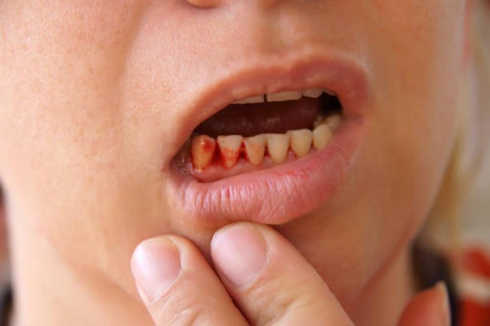 أسباب الإصابة بنزيف اللثة&nbsp;