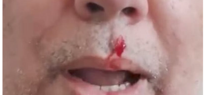 جانب من الكدمات والنزيف