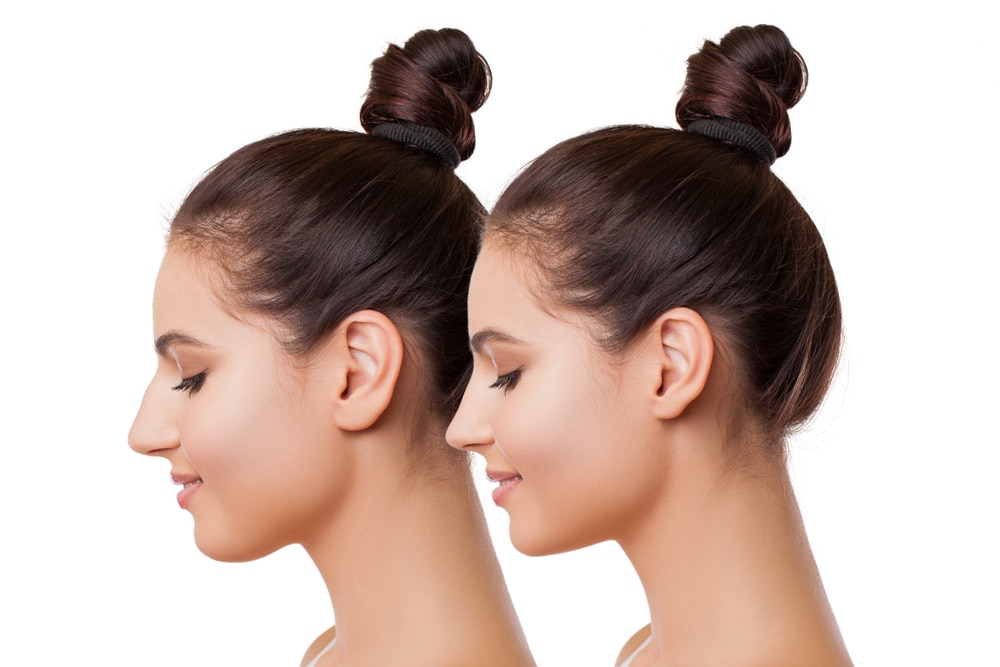 أنواع عمليات تجميل الأذن