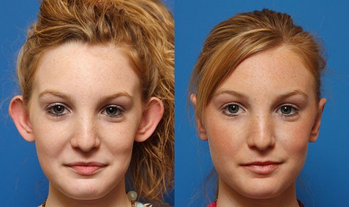 أنواع عمليات تجميل الأذن