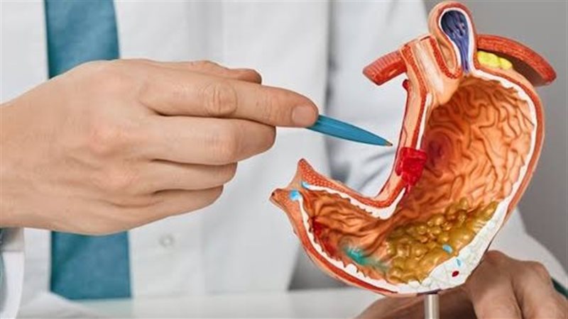 علاج قرحة المعدة
