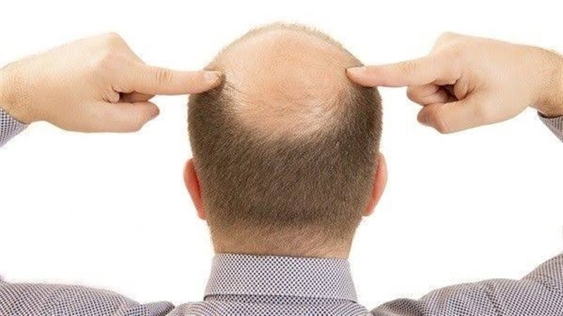 تساقط الشعر