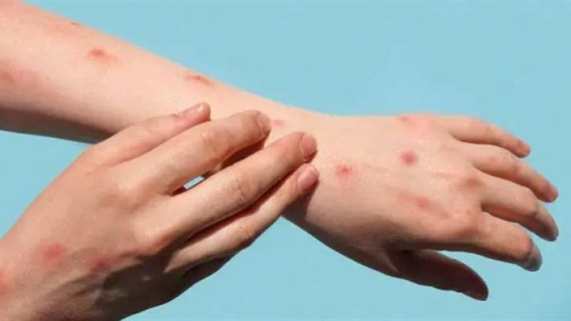 أعراض جدري القرود