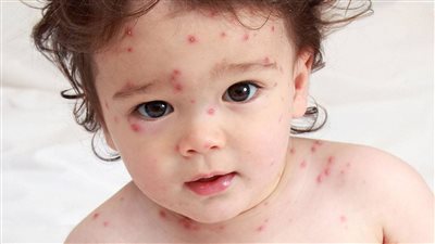 مرض الجدري.. أسبابه وأنواعه وأعراضه وعلاجه 