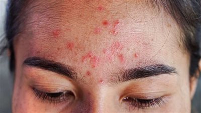 كيف يؤثر تراجع الكولاجين على نضارة الوجه وصحة الشعر؟