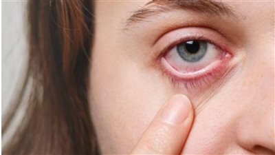 حساسية العين .. ما هى الأسباب والأعراض وطرق الوقاية ؟