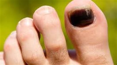 أعراض سرطان الأظافر التي لا يجب تجاهلها.. 5 علامات تحذيرية خطيرة