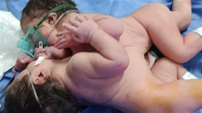 ولادة نادرة لتوأم ملتصق بالبطن بمستشفى الفيوم العام