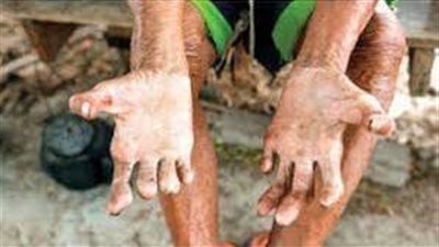 معلومات مهمة عن المرض وأسباب انتقاله..وزارة الصحة توفر علاج الجذام مجانًا