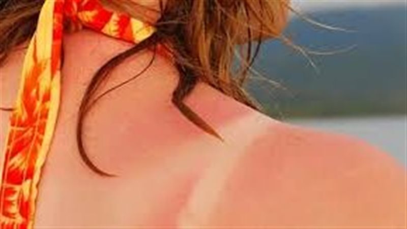 علاجات منزلية لحروق