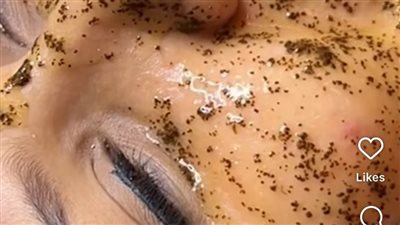 باستخدام النمل.. عيادة تجميل تستعين بطرق غريبة في تنظيف البشرة