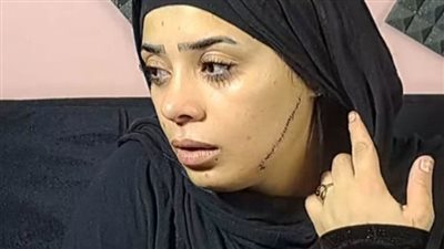 قصة «منصورة» المأساوية.. طليقة عريسها شوهت وجهها قبل زفافها 