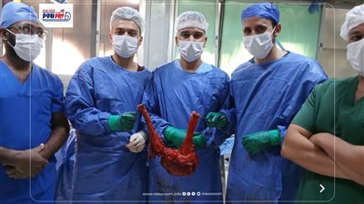فريق الجراحة بالمستشفى العام يستئصل ورم بالقولون يزن 7 كيلو جرام لمريض 