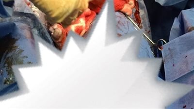 ولادتان قيصريتان ناجحتان في ظروف دقيقة بمستشفى أشمون العام بالمنوفية