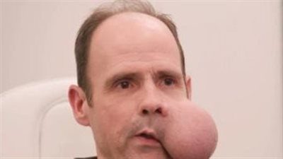 رجل أمريكي يعيش بورم يزن 2 كجم في وجهه وينتظر مساعدة الأطباء