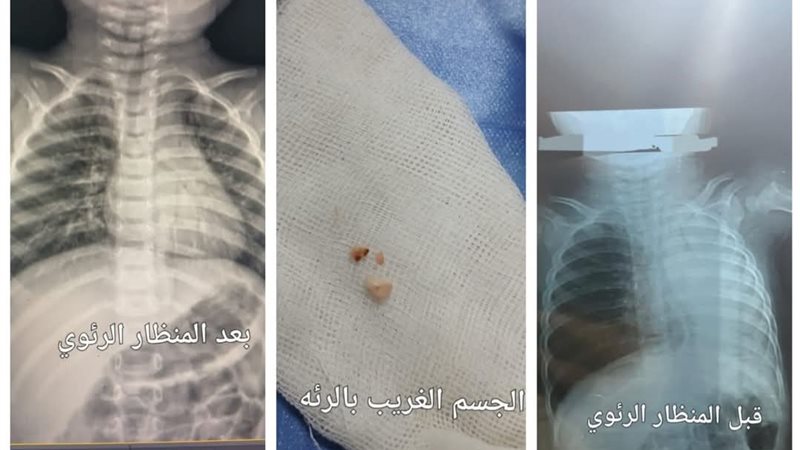 الحالة