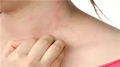 أعراض الحكة .. من الجفاف والتشققات إلى الطفح الجلدي