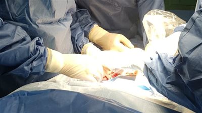إنقاذ حياة مولود يعاني من عيب خلقي نادر وعالٍ بمنطقة الشرج في المنوفية