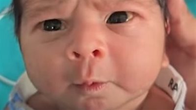 رضيع يدهش الأطباء بتعبيرات الدهشة التي ظهرت على وجهه منذ لحظة ولادته