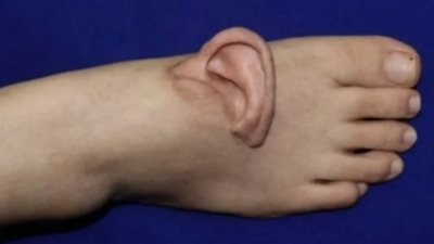 عملية ناجحة تنقل الأذن من القدم إلى موقعها الطبيعي لدى امرأة 	