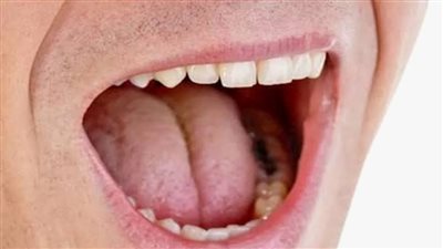 جفاف الفم أثناء الليل .. الأسباب الشائعة وطرق التعامل المجربة