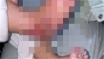 بلاغ ضد مركز طبي شهير بالقاهرة بعد إصابة طفلة بحروق جراء الإهمال