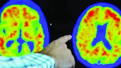 دراسة: خضار متوفر في كل بيت قد يحمي الدماغ من ألزهايمر  