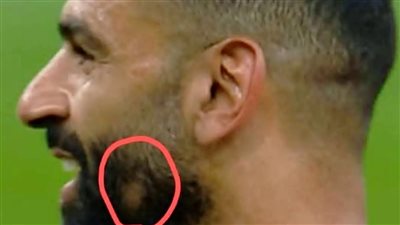 تساقط الشعر عند محمد صلاح يثير التساؤلات ..هل هي الثعلبة فعلًا؟