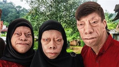 بسبب متلازمة نادرة.. قصة عائلة إندونيسية تتحول وجوهها إلى 