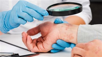 دراسة على مدار 25 عاما تكشف ارتباط الإكزيما بأمراض الأمعاء