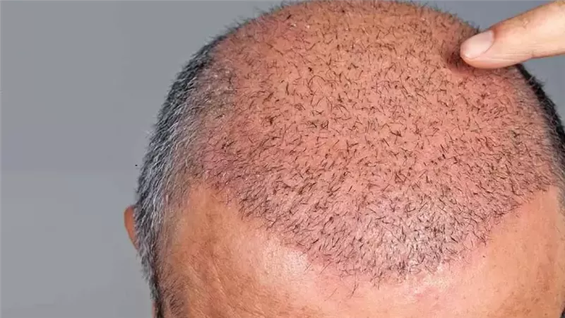 زراعة الشعر