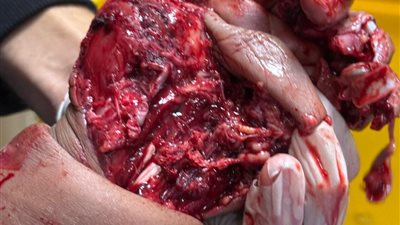 نجاح طبي في جامعة سوهاج.. إنقاذ ذراع طفل بعد حادث طاحونة قمح