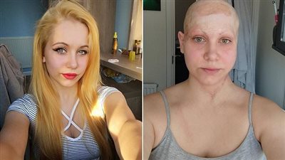 امرأة تفقد فروة رأسها بسبب حادث عمل وأطفالها لا يتعرفون عليها دون الباروكة 