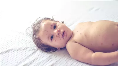 مع تزايد حالات الإصابة بالحصبة في لندن.. العلامات التي يجب الانتباه إليها