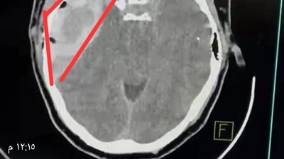 نجاح فريق طبي بمستشفى دمياط العام أنقذوا سيدة من نزيف حاد بالمخ