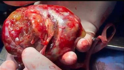 جامعة القاهرة تنجح جراحة قلب نادرة لاستئصال ورم ضخم بمستشفى قصر العيني