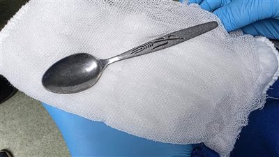 في ليلة العيد.. فريق طبي بالمنوفية ينجح في استخراج ملعقة من معدة فتاة